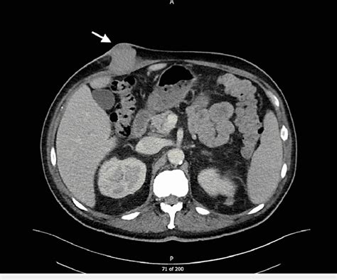 Axial Ct Image Showing Dominant Lesion Arrow In The Right Upper