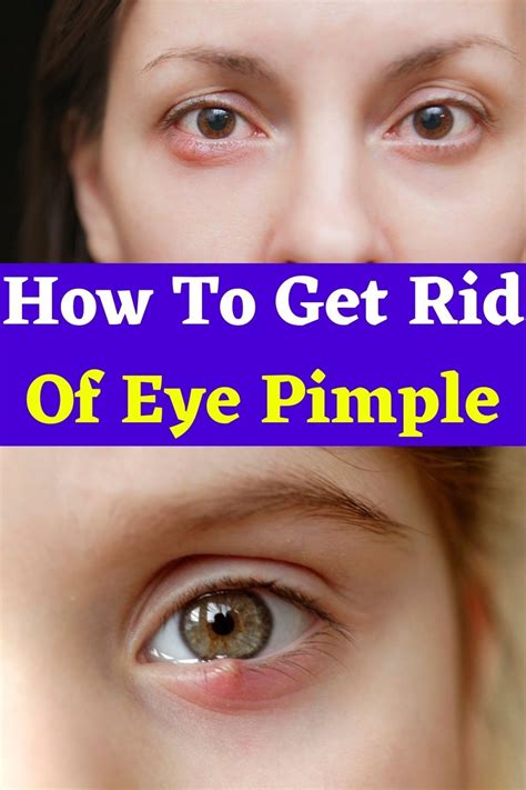 How To Get Rid Of Eye Pimple In 2021 Pimples Common Eye Problems