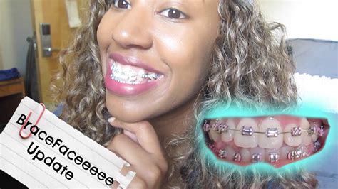 The result is, the nerves in your mouth and jaw temporarily stop transmitting pain impulses to the brain! I Got My Bottom Wire! | Braces Update Month 2 Vlog 3 - YouTube