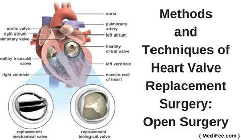 Surgery For Heart Valve Replacement