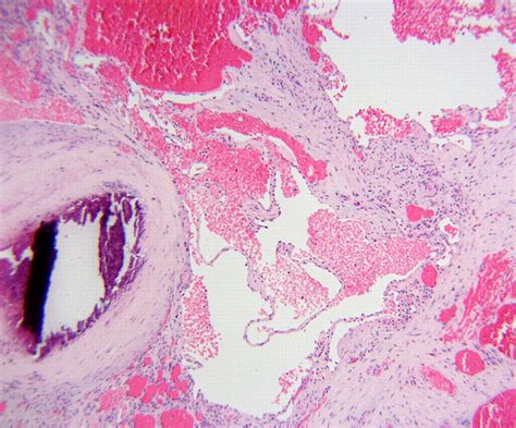 Soft Tissue Cavernous Hemangioma Radiographics