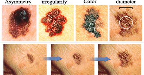 Melanoma Skin Cancer Patients Dont Regularly Perform Thorough Skin