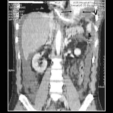 Contrast Enhanced Ct Thorax Shows Dilated Stomach With Air Fluid Level