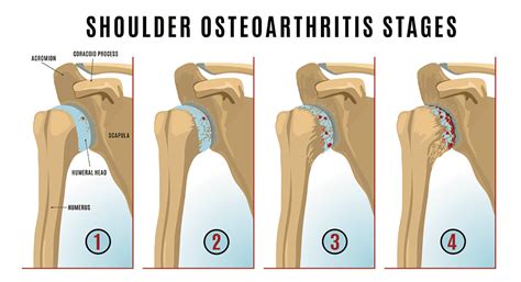 Shoulder Arthritis Albuquerque Nm Modern Pain And Spine