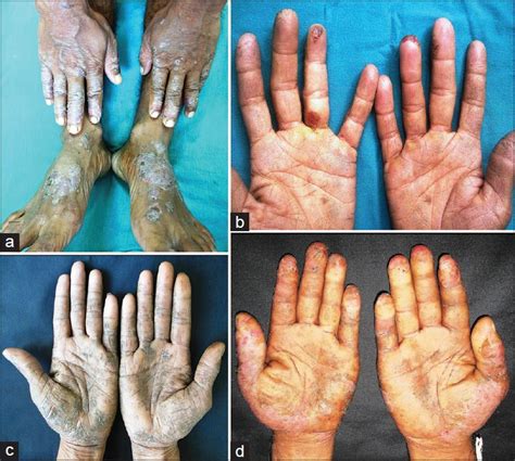 Occupational Contact Dermatitis Among Construction Workers Results Of