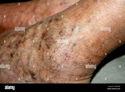 Leg Varicose Veins Phlebeurysm Thrombophlebitis Leg In Veins Stock