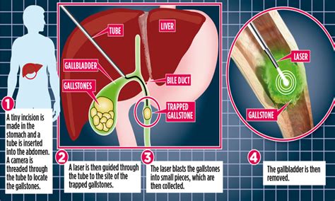 How To Take Care Of Your Liver After Gallbladder Removal