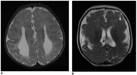 Congenital Brain Malformations Radiology Key