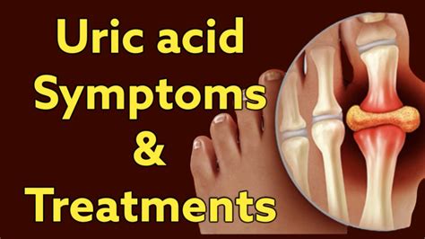 Understanding Uric Acid Symptoms Causes And Treatment Options Youtube