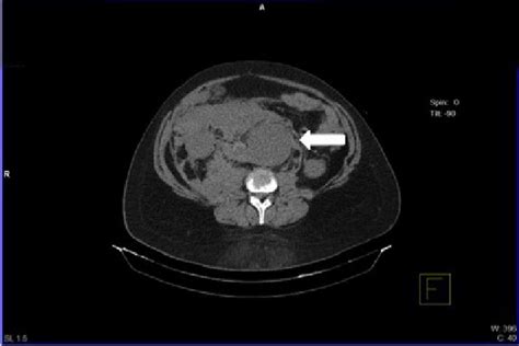 Plain Abdominal Ct Scan Without Contrast Shows Large Dissecting