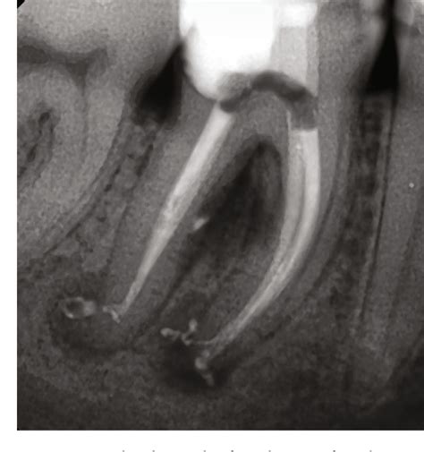 Figure 3 From Symptomatic Apical Periodontitis Of The Mandibular First