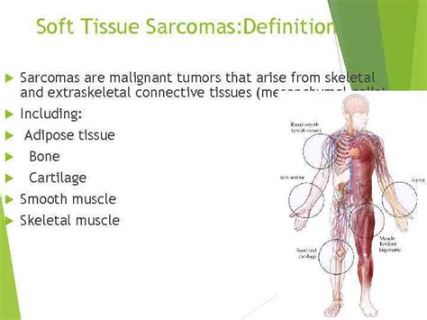 Sarcoma Of Soft Tissue Dr Olga Vornicova Oncology