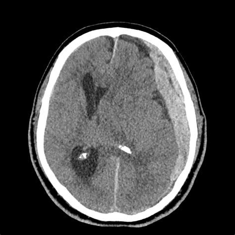 Pre Operative Condition Subdural Hematoma With Uncal Herniation Sexiz Pix