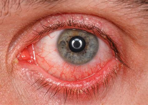 What Are The Common Causes Of Swelling Under The Eye