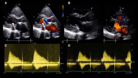 Late Onset Bioprosthetic Mitral Valve Thrombosis Treated With Apixaban
