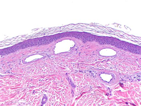 Virtual Grand Rounds In Dermatology 20 Unusual Vascular Pattern