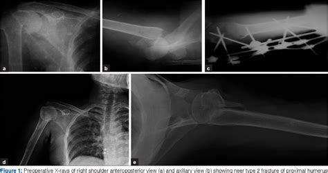 Functional Outcome Of Closed Fractures Of Proximal Humerus Managed By