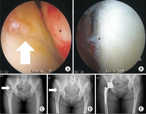 Figure 2 From Arthroscopic Repair Of Acetabular Labral Tears Associated