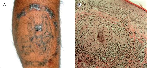 Granulomatous Tattoo Reaction In A Young Man The Lancet