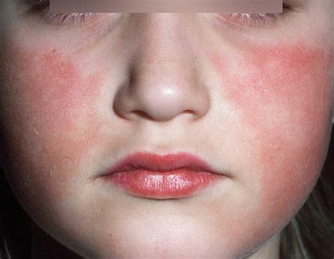 Maculopapular Rashes Causes With Pictures