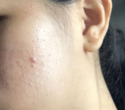 Tiny Bumps On Cheeks And Forehead Hormonal Acne Forum