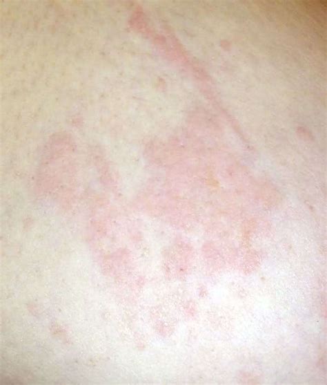 Inflammatory Breast Cancer Pictures Bruise Itchy Breasts Rash Tumor