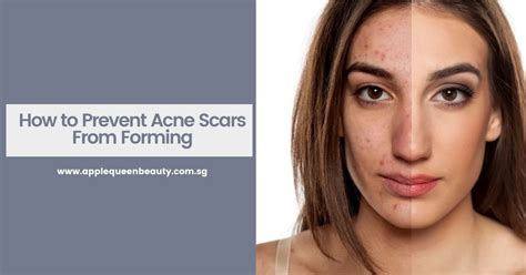 A Complete Guide On How To Prevent Acne Scars From Forming