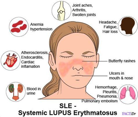 Systemic Lupus Erythromatosus Platform Cme