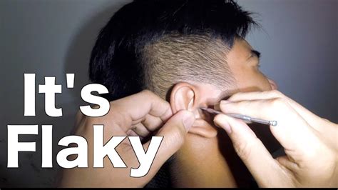 Removing Mans Dry And Flaky Earwax Using An Ear Curette Youtube