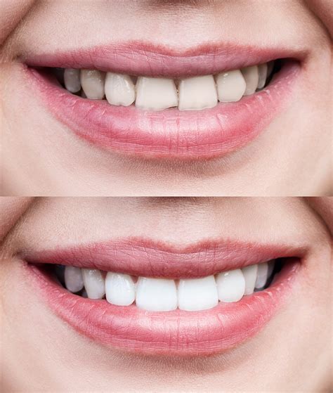 A Smile Makeover In Medford Can Boost Your Confidence