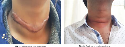 Figure 3 From Management Of Post Thyroidectomy Scar Semantic Scholar