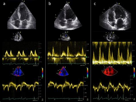 Echocardiographic Assessment Of Cardiac Remodelling And Diastolic