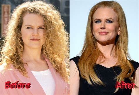 Nicole Kidman Before And After Cosmetic Surgery Plastic Surgery Mistakes