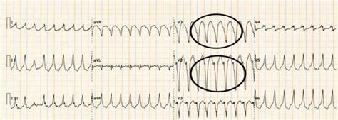 Right Ventricular Outflow Tract Tachycardia Wikidoc