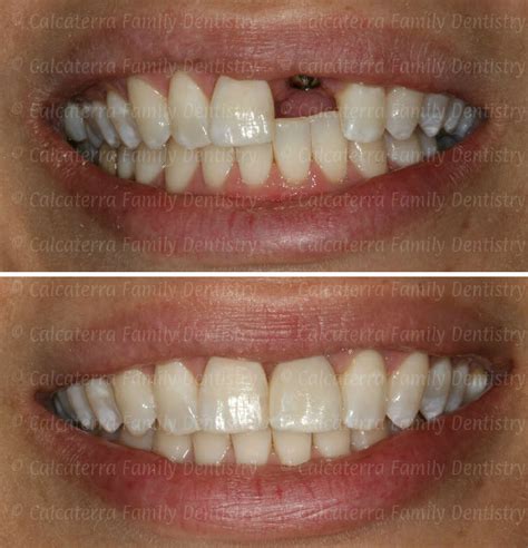 From A Flipper To A New Front Tooth Dentist Orange Ct