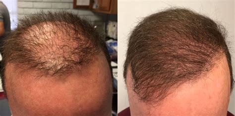 Individual results may vary from individual to individual. Hair Transplant Before & After | Hair Restoration Before ...