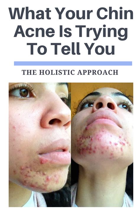 What Your Chin Acne Is Trying To Tell You Chin Acne Hormonal Chin