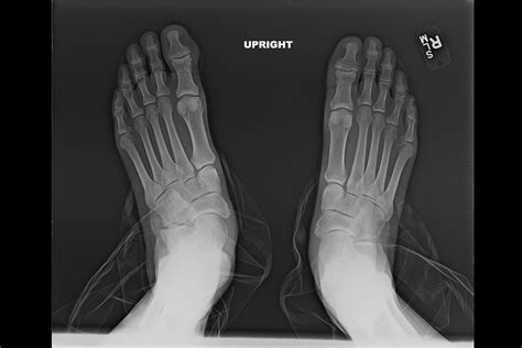 Ortho Dx Chronic Foot Pain And Deformity Clinical Advisor