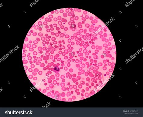 Blister Cell Blood Test Red Blood 스톡 사진 1613473555 Shutterstock