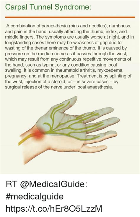 Carpal Tunnel Syndrome A Combination Of Paraesthesia Pins And Needles