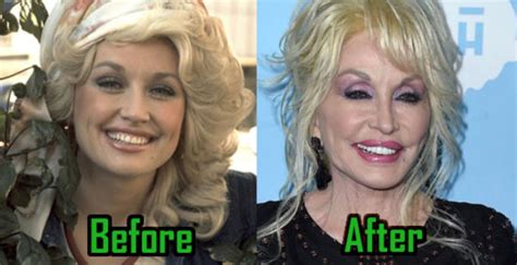 Dolly Parton Cant Live Without Plastic Surgery Celebritysurgeryicon