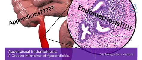 Appendiceal Endometriosis Endonews