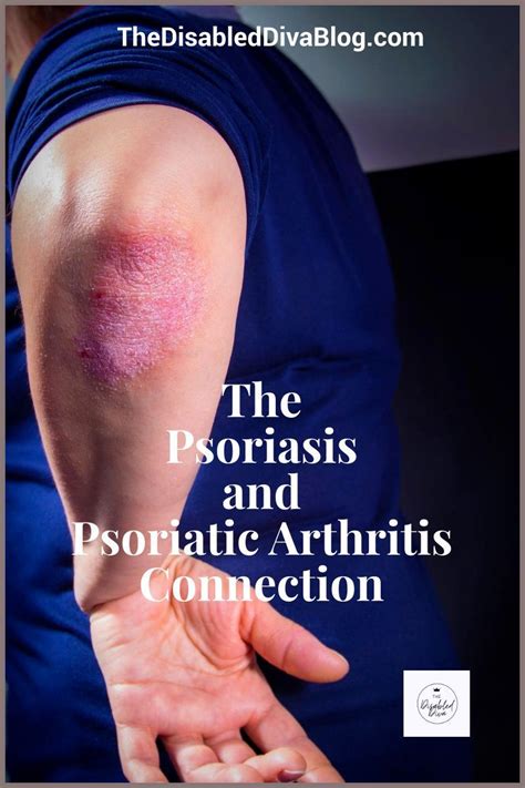Psoriatic Arthritis Artofit