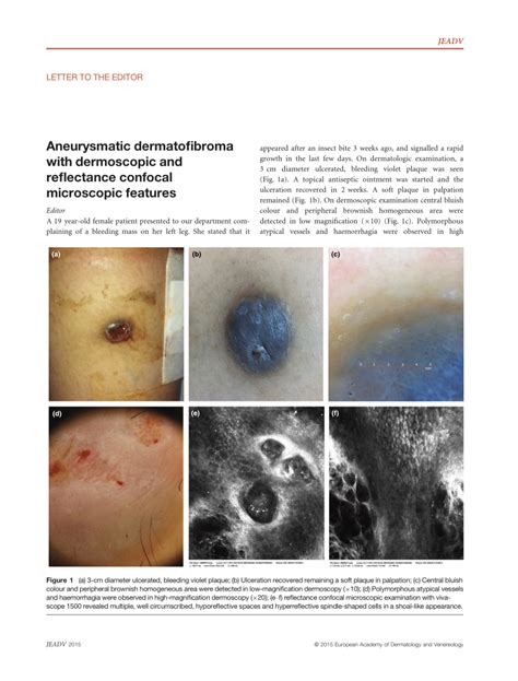 Pdf Aneurysmatic Dermatofibroma With Dermoscopic And Reflectance