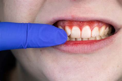 Periodontics Treatments For Gum Disease Dental Care Of Morrisville