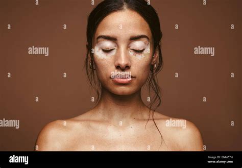 Vitiligo Beauty Hi Res Stock Photography And Images Alamy
