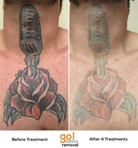 After 4 Laser Tattoo Removal Treatments We Have Significant Fading And