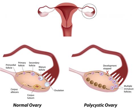 What Is A Simple Ovarian Cyst With Pictures