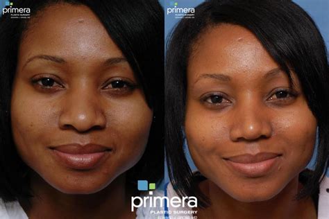 Rhinoplasty Before And After Pictures Case 11 Orlando Florida