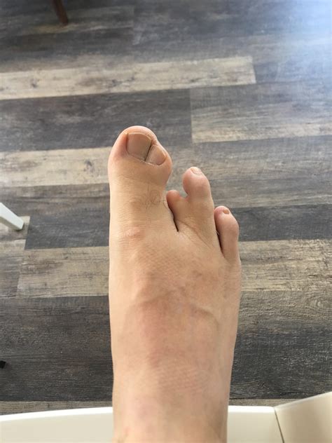 I Was Born With 3ish Toes On My Right Foot Mildlyinteresting